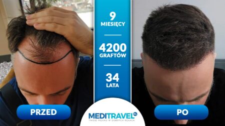 Przeszczep włosów ratunkiem dla pewności siebie?